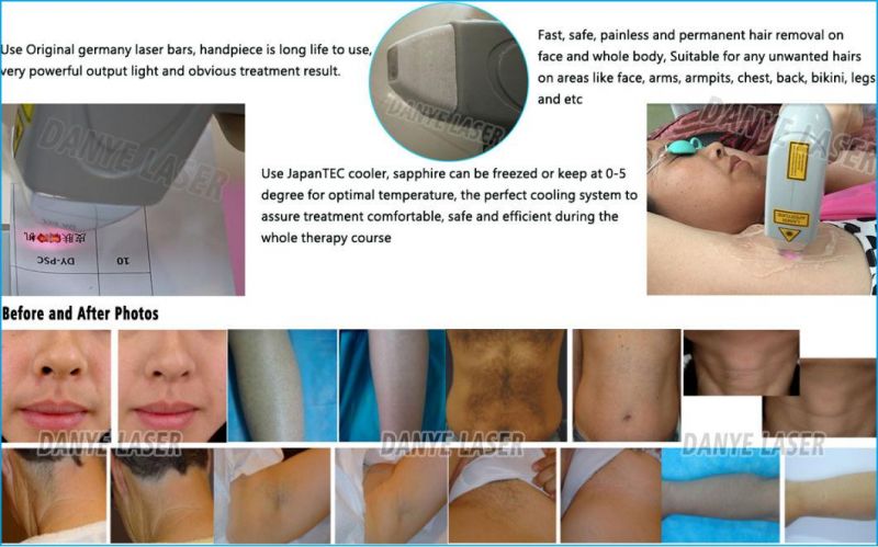 All Skin Types Hair Laser Ice Machine 755nm 808 Nm 1064nm Three Waves Laser Hair Removal Professional Clinc