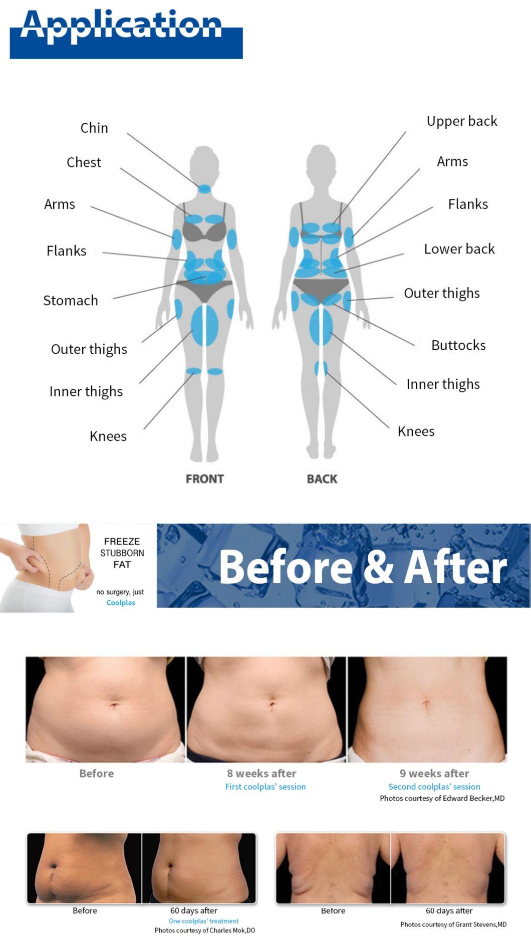 Consultant Dr. Coolplas 360 Cryo Slimming 2021 Vacuum Cryolipo Fat Removal Cryolipolysie