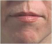 Monopolar RF Face Lifting Eye Wrinkle Removal Forhead Wrinkle Removal The Return to Youth Look