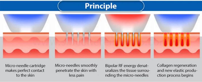 Jo. Radio Microneedle Micro Frequency Needle Microneedling Fractional RF Face Lifting Skin Rejuvenation