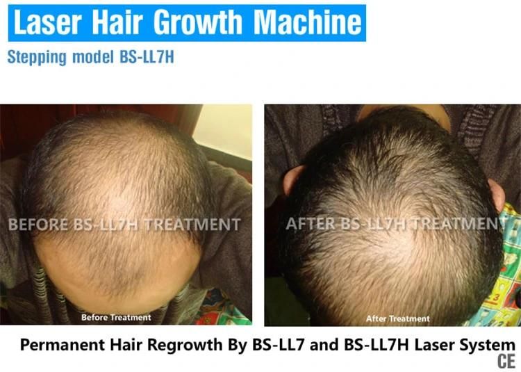 (BS-LL7H) 650nm Diode Laser Hair Growth Machine