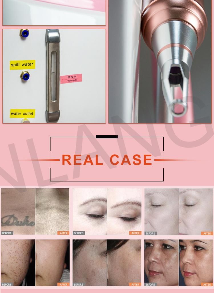 Renlang 2019 Best Selling Products Shr RF Opt IPL Skin Rejuvenation Hair Removal Laser System with Low Price