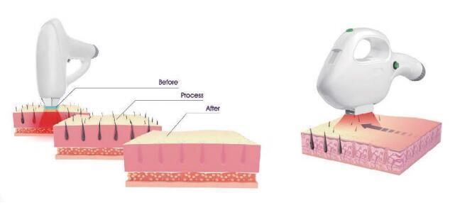 Germany Permanent Hair Removal Laser Diode Laser IPL Machine