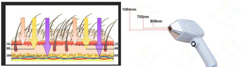 3 Wave Hair Removal Alexandrite Laser Machine Portable Diode Laser 755 808 1064 Soprano Ice