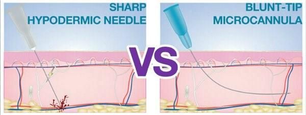 Magicalift Blunt Cannula Injection for Filler