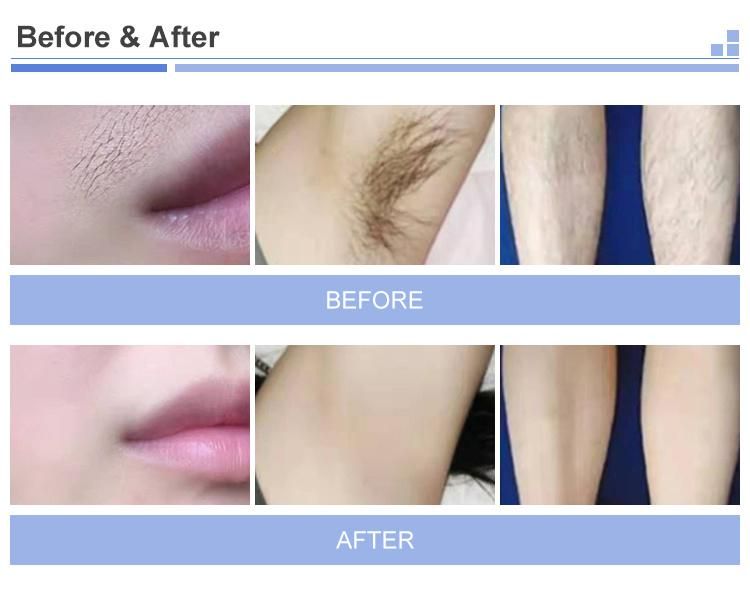 Permanent Professional 755 1064 808nm Diode Laser Hair Removal