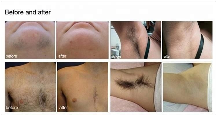 Painless  Permanent Hair  Removal /808  Fibercoupled Diode  Laser  /Laser  Hairline Removal