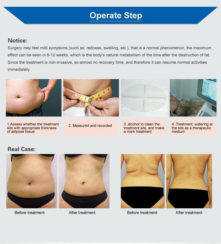 Effective Fast Removal Body Liposonix Slimming Machine