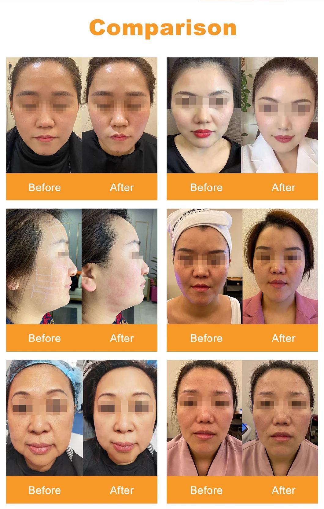 Newest Portable 4D Hifu Face Lifting Skin Machine