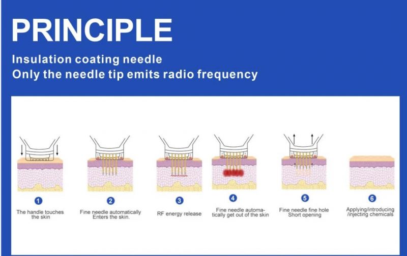 Fractional Microneedling RF Vivace Radio Frequency Microneedling Microneedle Radiofrequency Micro Needle Fractional RF