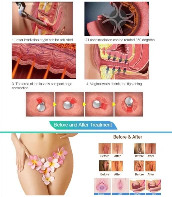 RF Drive Fractional CO2 Laser for Scar Removal Vaginal Rejuvenation