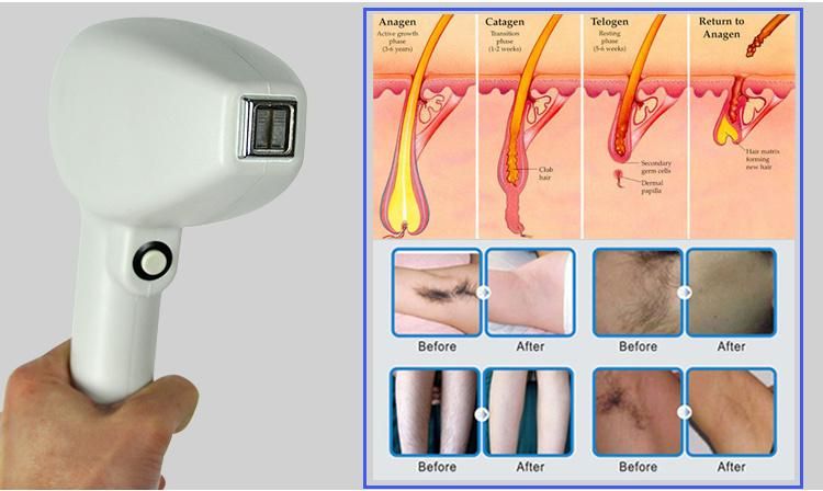 Best Selling Stationary Style 808nm Diode Laser Hair Removal Equipment with Powerful