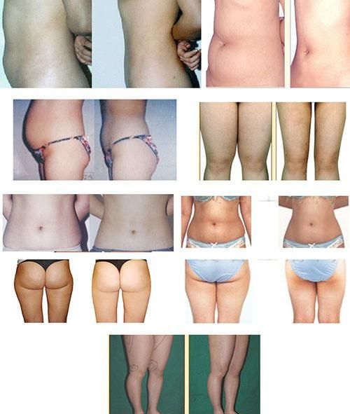 Hf-901 Body Shaping & Slimming Cavitation Beauty System