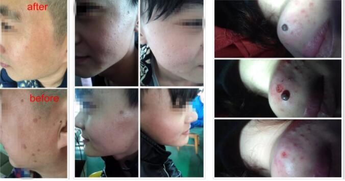 CO2 Laser Pigmentation & Wrinkle Removal Beauty Equipment Machine