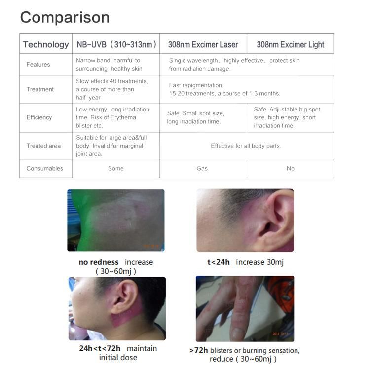 Narrow Band UVB Lamp Treatment of Vitiligo Psoriasis Pityriasis Rosea Eczema UV Phototherapy Apparatus