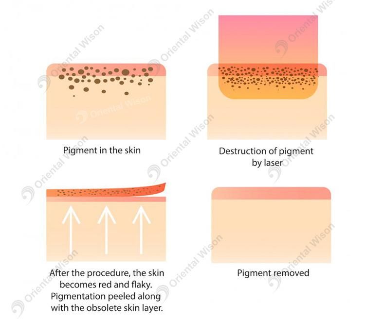 Picomed 1064 Nm 755nm 532nm Pico Laser Picosecond Laser Chloasma Removal Machine Price