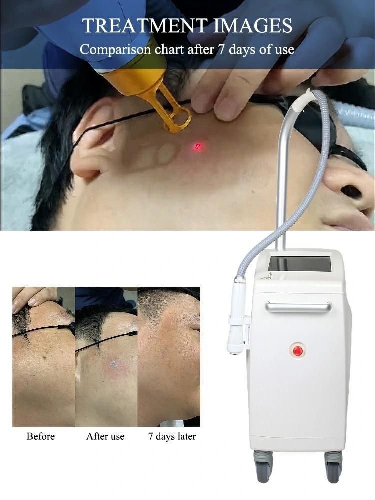 Newest Picosecond Salon Laser Tattoo Removal Machine Laser Skin Rejuvenation