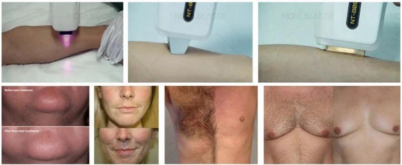 Medical Diode Laser 808nm for Hair Removal