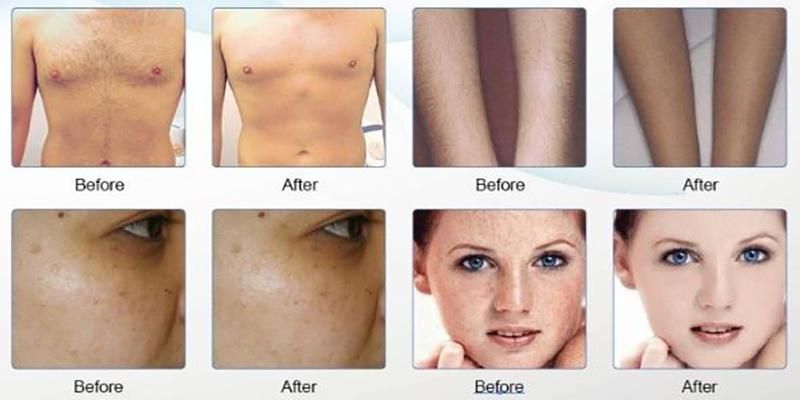 V-Hair Removal, Blood Vessels Removal, Pore Remover, Face