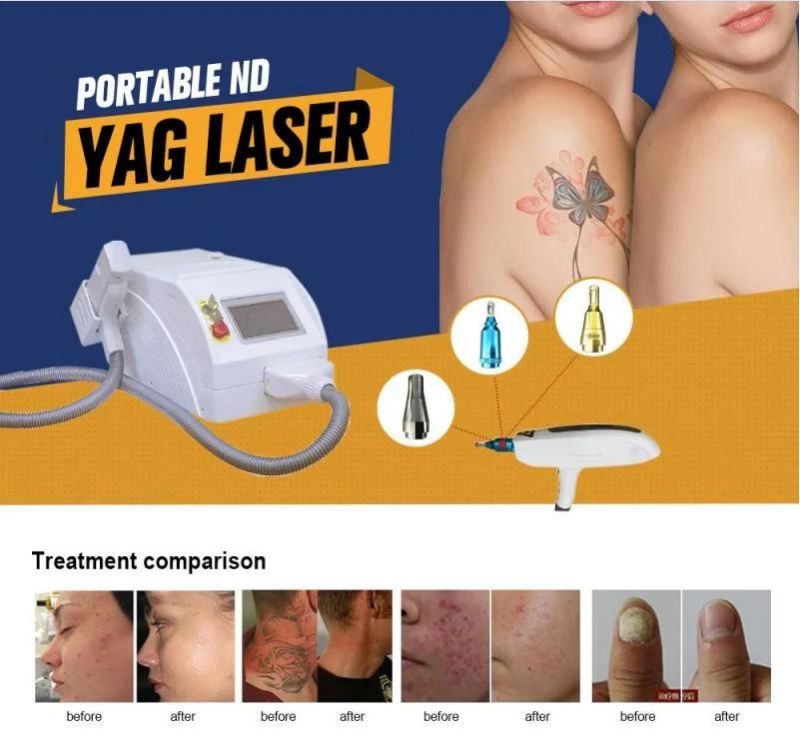 Competitive Price Portable Ndyag Laser Q Switch ND YAG Laser Tattoo Birthmarks Pigment Removal Equipment for Salon