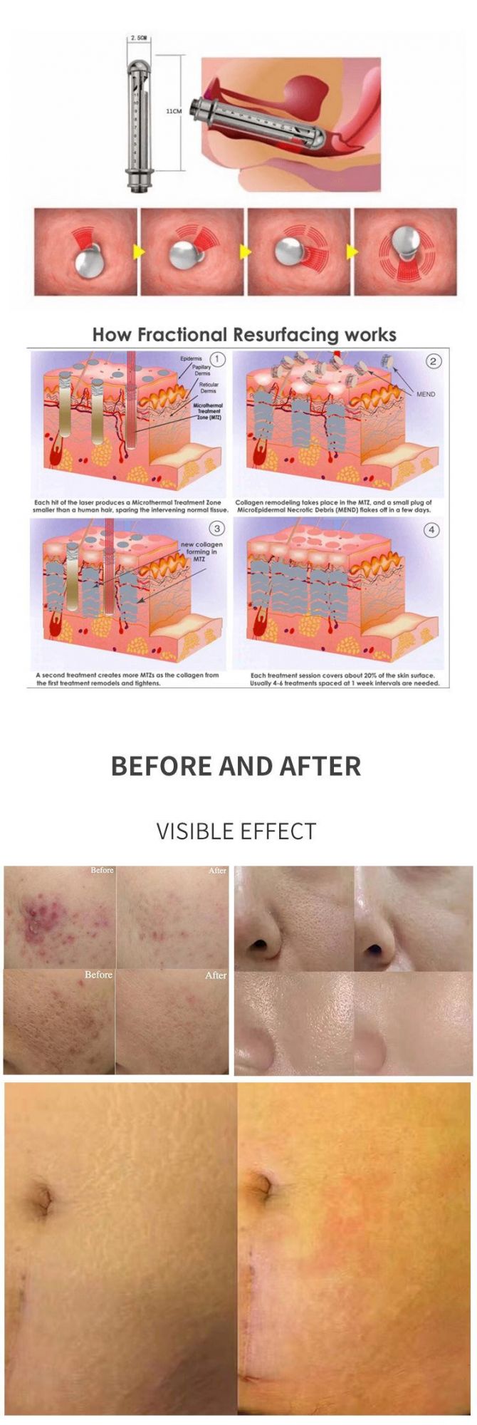 Skin Tightening Acne Treatment Machine CO2 Fractional Laser Scar Removal