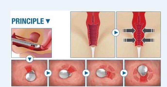 Fractional CO2 Laser Skin Resurfacing Vaginal Tightening Beauty Machine