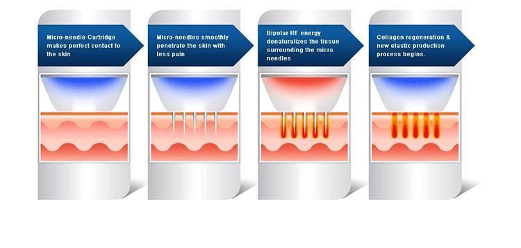 Effective 2 in 1 Fractional RF Microneedle with Cold Hammer Radiofrequency Skin Tightening Face Lifting Machine Skin Resurfacing