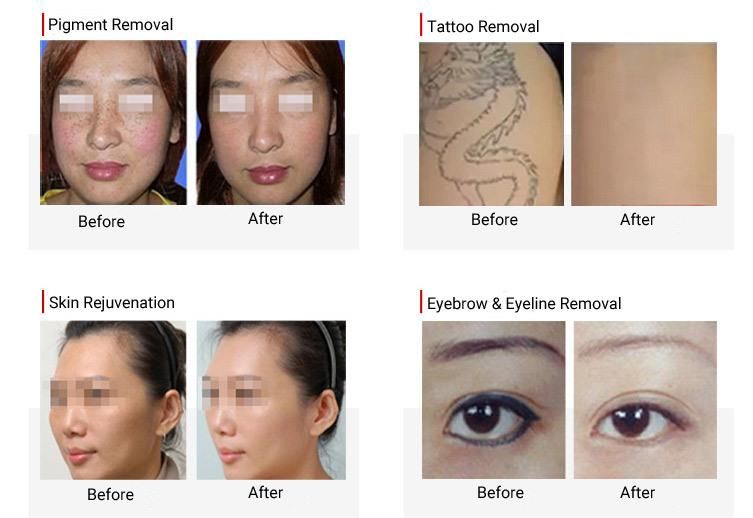 Q-Switch ND YAG Pico Second Laser Tattoo Removal for Pigment Melasma Removal