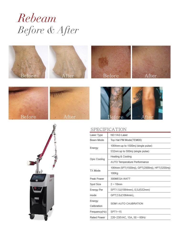 1064nm/532nm Eo Q-Switch ND YAG Laser for Tattoo Removal