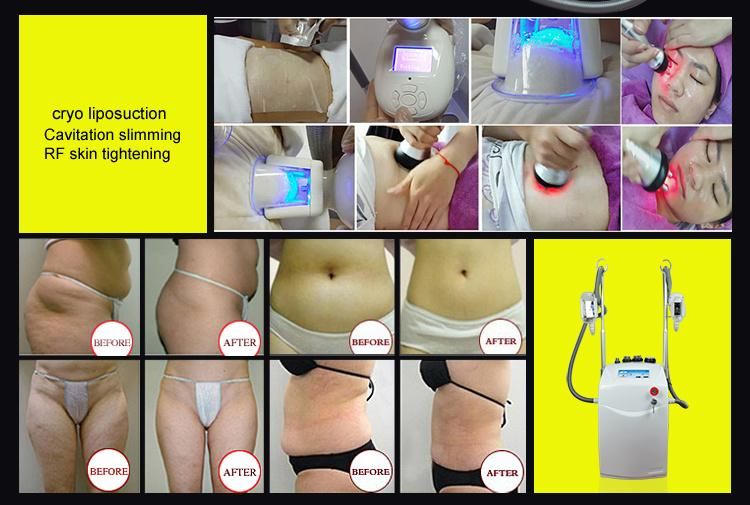 Portable Fat Freezing Body Slimming Weight Loss Cryotherapy Beauty Machine