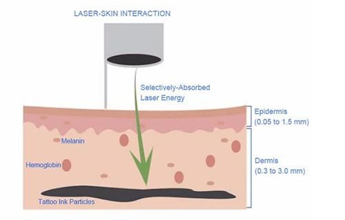 ND YAG Laser Pigment and Tattoo Removal Beauty Machine