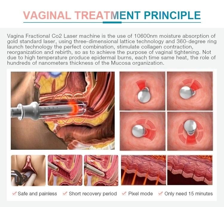 Fractional CO2 Vaginal Tightening Laser Medical Laser Machine for Scar Removal