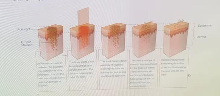 V-Pigment Removal Skin Tightening Blood Vessels Removal Face Resurfacing LED