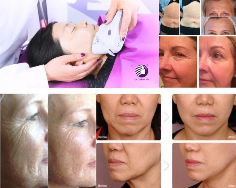 2D 3D Hifu Beauty Salon Equipment for Anti-Wrinkle