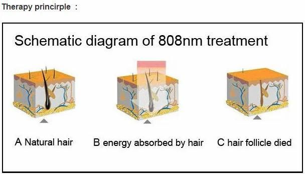 810nm laser diode laser epilation laser HS 811 machine by shanghai med apolo medical