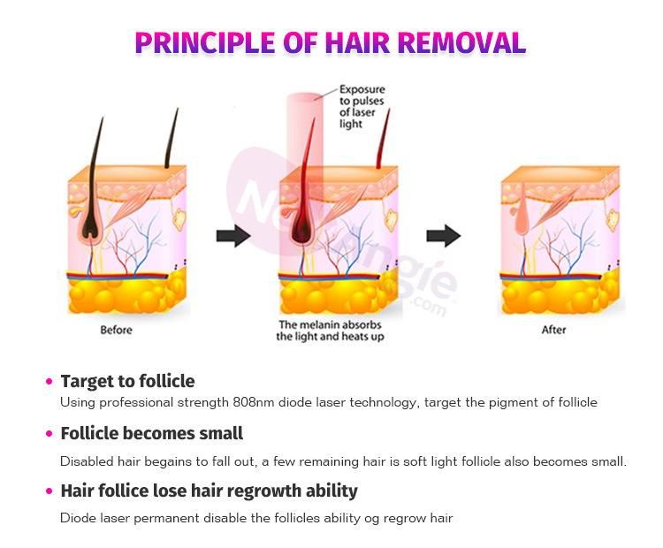 Permanent 3 Wavelength Diode Laser 808nm Hair Removal Laser Machine