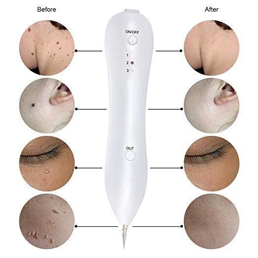 Skin Tightening Pigmentation Corrector Mole Tattoo Removal Pen