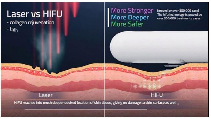 9d High Intensity Focused Ulrasound, Radar Higu, Liposonic, Hifu Machine