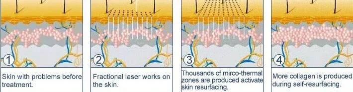 CO2 Fractional Laser Scar Removal Skin Resurfacing Machine