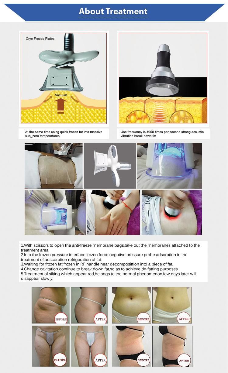 2019 Most Popular Fat Freezing /Cryolipolysis Slimming Machine/Criolipolisys Machine