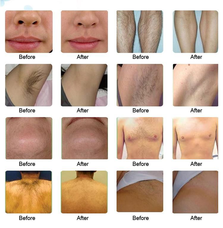 1064nm&808nm&755nm Laser Blond Hair Removal for Face and Body 3 Wavelength Diode Laser Hair Removal