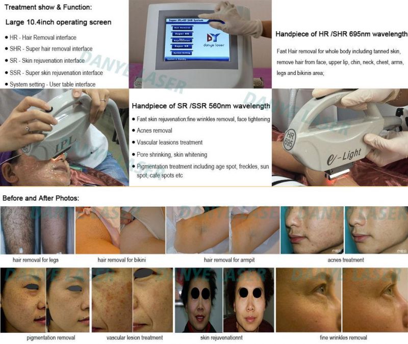 Opt Elight IPL Shr Hair Removal Machine Skin Rejuvenation Beauty Machine