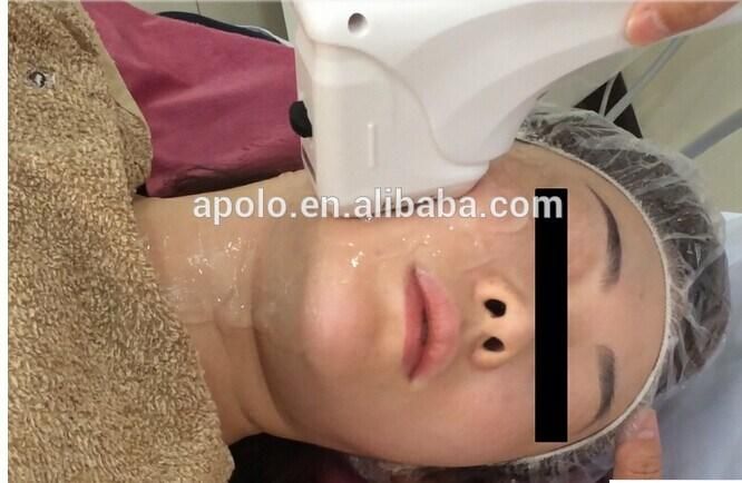 Wrinkle Removal Hifu Machine Ultraformer Hifu for Body Contouring