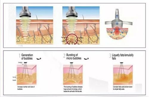 Unique Ultrasound Liposuction Ultra Cavitation Professional Machine