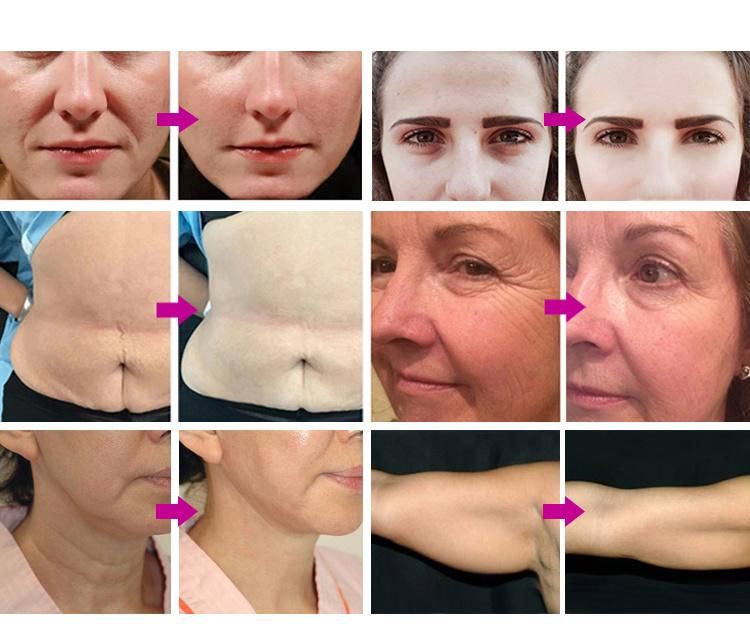 Portable 7D Hifu Wrinkle Removal Skin Tightening Salon Facial Machine Beauty Equipment