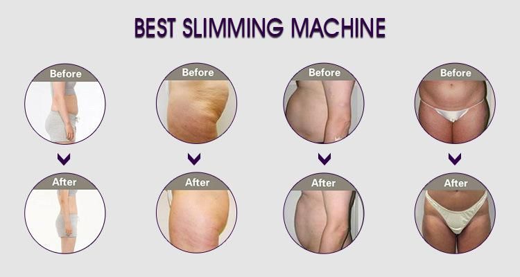 Latest Cryotherapy Fat Freeze/Cryo RF Slimming Machine/Ultrasonic Cavitation Slimming Machine