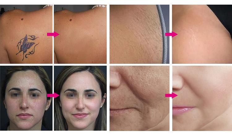 Konmison Far Infrared Optional Continuous and Pulse RF IPL Laser Hair Removal Machine