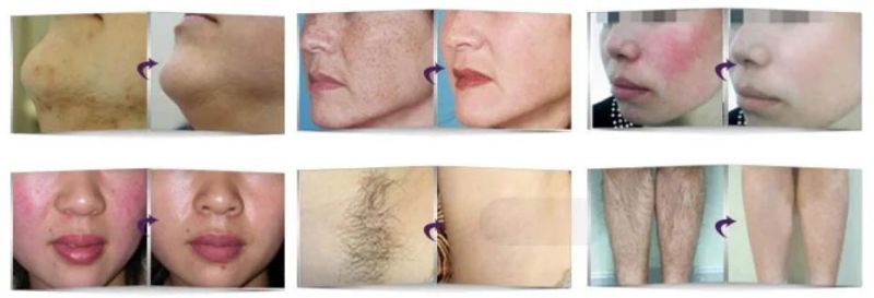 Virtually Painless Hair Removal Pigment Therapy Beauty Machine