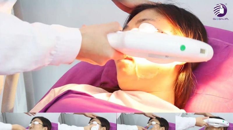 No Pain Hair Removal Vacular Therapy Shr SSR Beauty Equipment