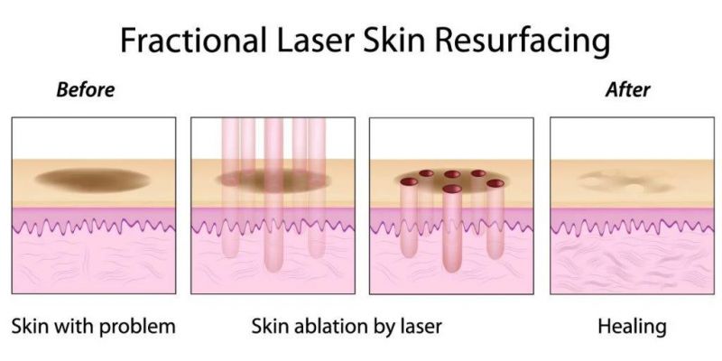 RF Tube CO2 Laser with Ance Remove Skin Care Beauty Machine